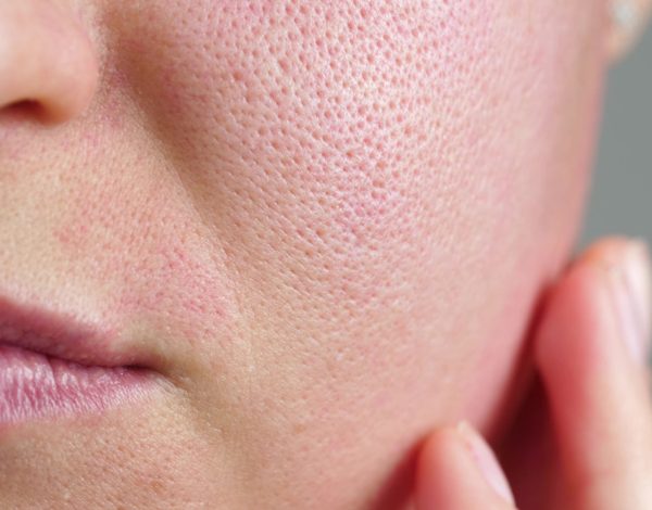 home-remedies-for-shrinking-pores-naturally